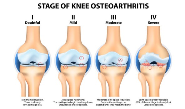 Knee-Osteoarthritis-Stages